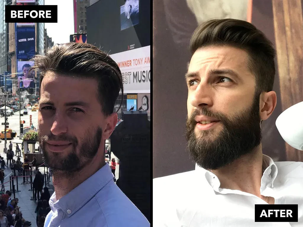 Patchy beard growth
